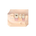 Anatomical Implant Restoration Crown
